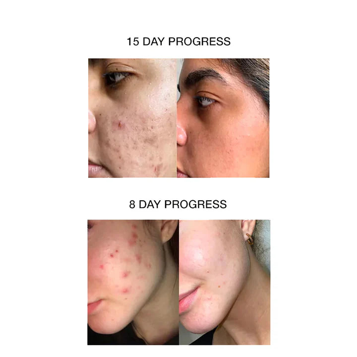 ACNE CLARIFYING GEL COMBO