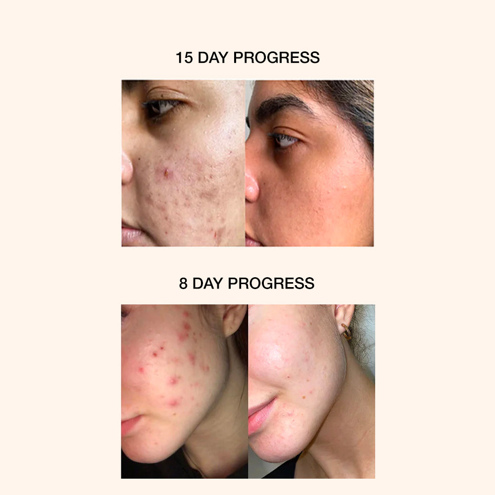 ACNE CLARIFYING GEL